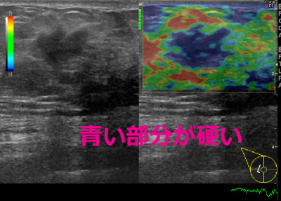 撮影例：乳腺超音波　青い部分が固い