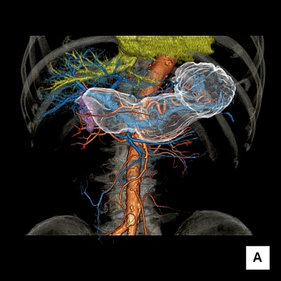 腹部血管CT