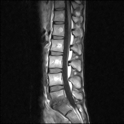 腰椎 MRI