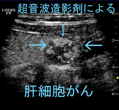 腹部超音波