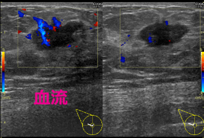 撮影例：乳腺超音波　血流