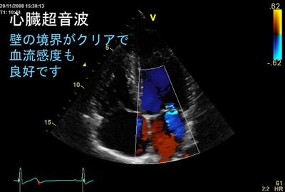 心臓超音波