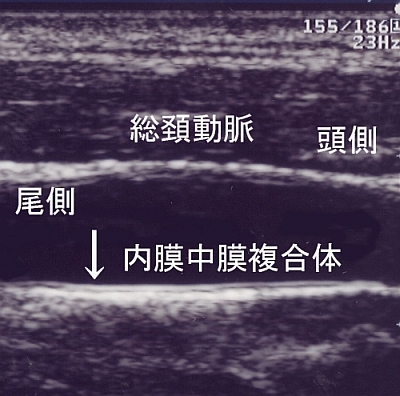 腹部超音波