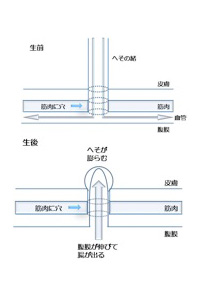 臍ヘルニアとは