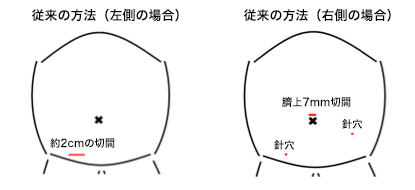 手術の内容